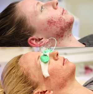 Instagram post by @lucyhatesacne