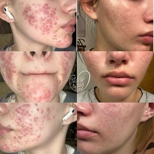 Instagram post by @lucyhatesacne