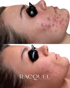 Instagram post by @lucyhatesacne