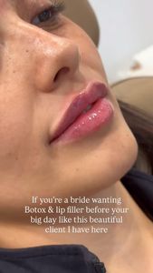 Instagram post by @aestheticsbyliz.rn