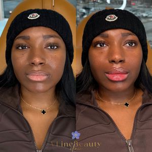 Instagram post by @selma_vlinebeautyclinic