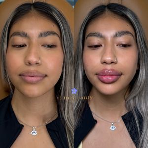 Instagram post by @selma_vlinebeautyclinic