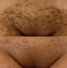 Instagram post by @peskinlaser