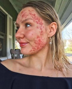 Instagram post by @theblemishqueen